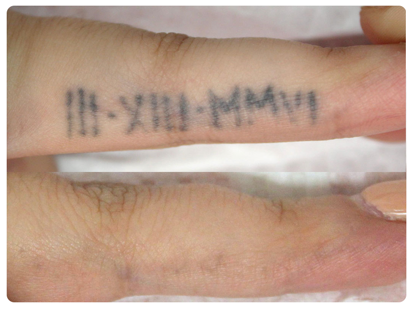 Before and after complete laser tattoo removal of a finger tattoo, Framingham client