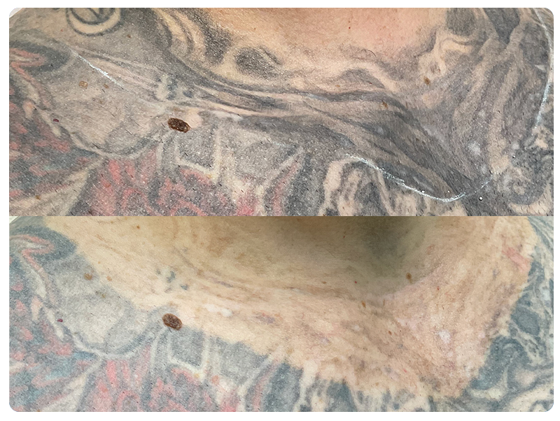 Before and after fading of a large tattoo for a cover up, Framingham client