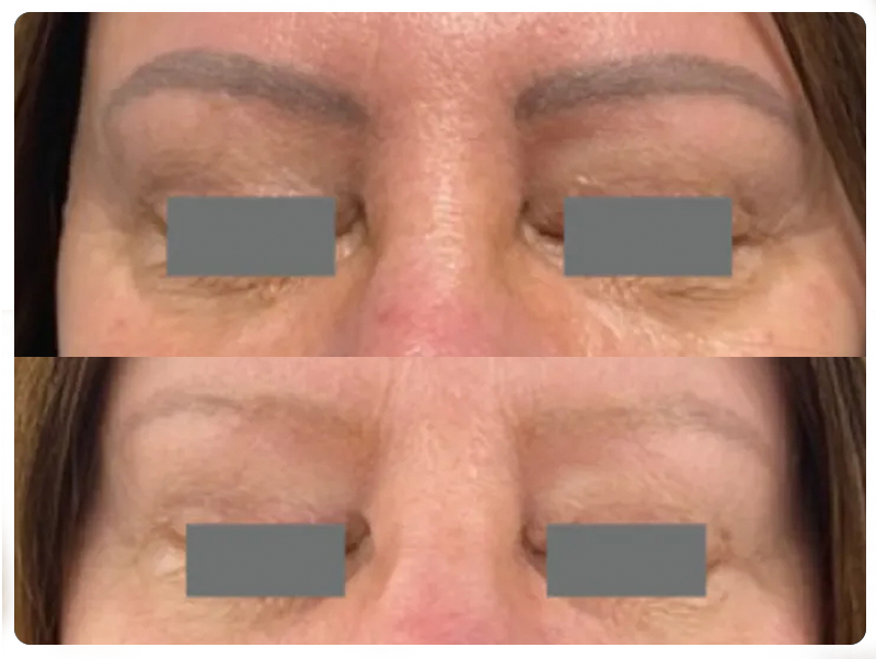 Before and after removal of eyebrow permanent makeup, Framingham client
